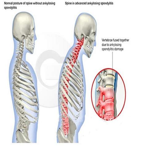 Hunchback Kyphosis Posture Correction Belt Magnetic Unisex Back Support