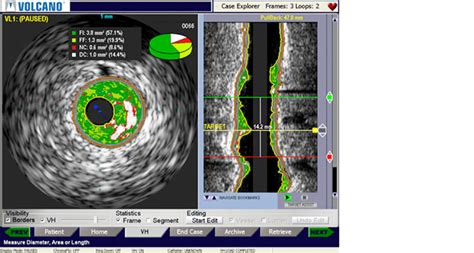 VH IVUS Philips Healthcare