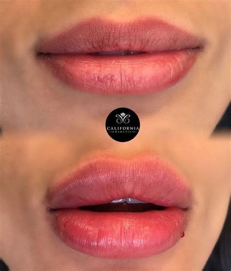 Regardez Cette Photo Instagram De Californiacosmetics • 920 Mentions Jaime Botox Lips Lip