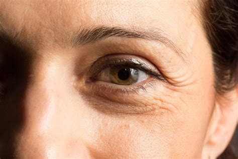What Causes Lines And Bags Under Your Eyes At Jacqueline Sadler Blog