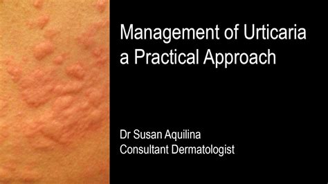 Management Of Urticaria A Practical Approach YouTube