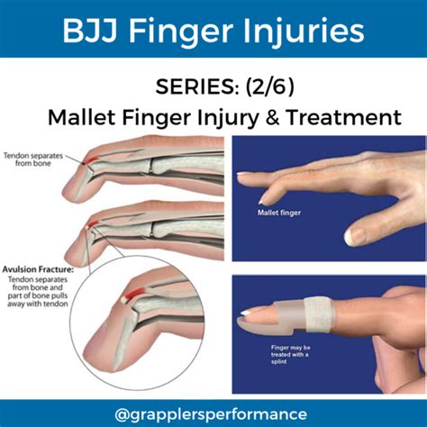 Common Bjj Finger Injuries Part Grapplers Performance