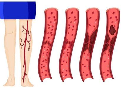 Trombosis venosa Tipos síntomas y manejo Varic es en Murcia