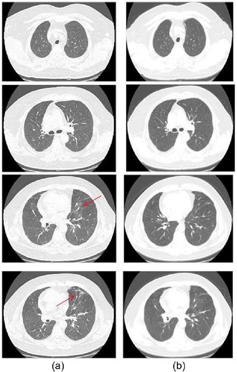 Chest High Resolution Computed Tomography Representative Lung Layers