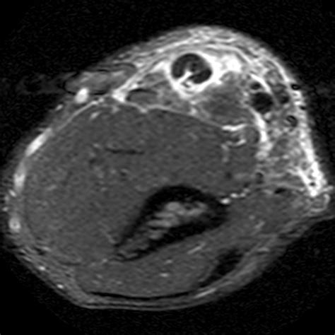 Distal Biceps Tendon Rupture Elbow Radsource