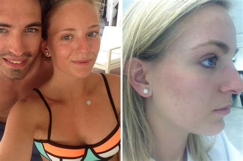 My Acne Story And Horrific Experience With Roaccutane — Wholesome Stef