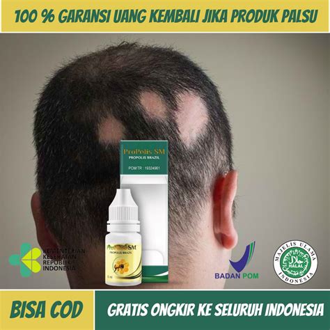 Jual Obat Alopecia Areata Kebotakan Rambut Pada Kepala Penumbuh Botak