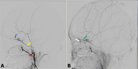 A And B Digital Subtraction Angiography Of The Right External Carotid