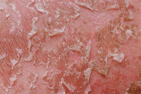 Flaking Cell Scales Irritated Reddened Skin Often Accompany Sunburn