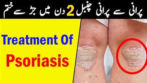 Treatment Of Psoriasis Chambal Ka Ilaj How To Use Dermax