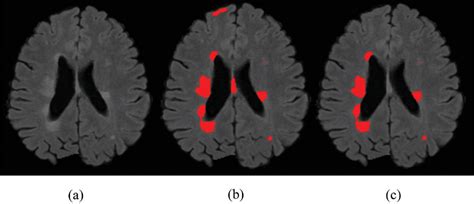 Figure 5 From Automatic And Robust Segmentation Of Multiple Sclerosis Lesions With Convolutional