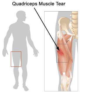 Quadriceps Strain Specialist | 🩺Singapore Sports & Orthopaedic Surgeon