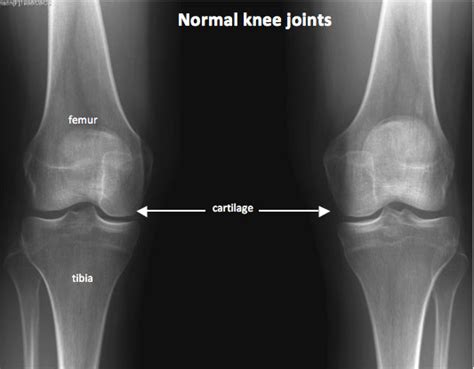 Knee Xray Santa Monica Ca Commons Clinic