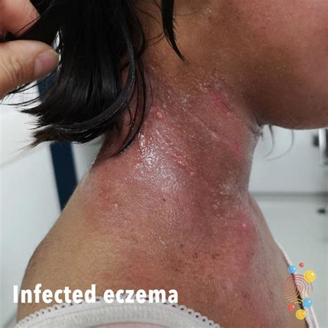 Eczema On Neck