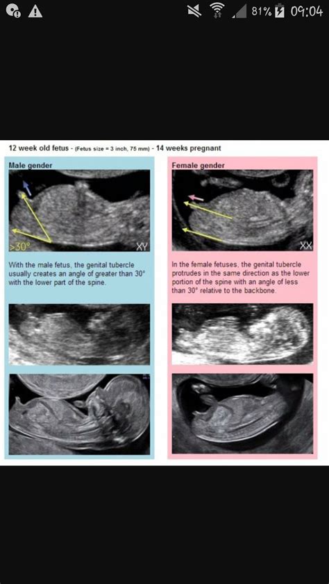 Echographie Er Trimestre Fille Ou Garcon Semaines D Am Norrh E