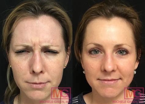 Before After Botox For Crows Feet And Glabella Dr Michele Green Is