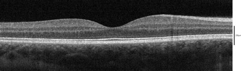 File:SD-OCT Macula Cross-Section.png - Wikipedia