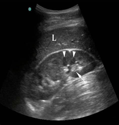 Renal Images Emergency Ultrasonography