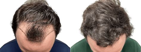 Hair Transplant Cost In San Juan Puerto Rico Maxim Hair Restoration