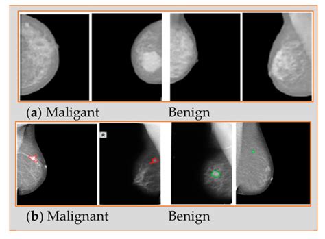 Applied Sciences Free Full Text Breast Cancer Detection Using