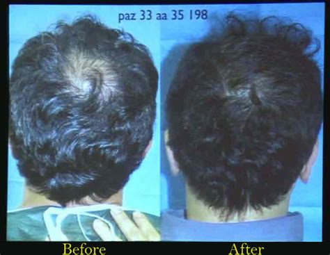 Best Hair Fall Treatment in Delhi