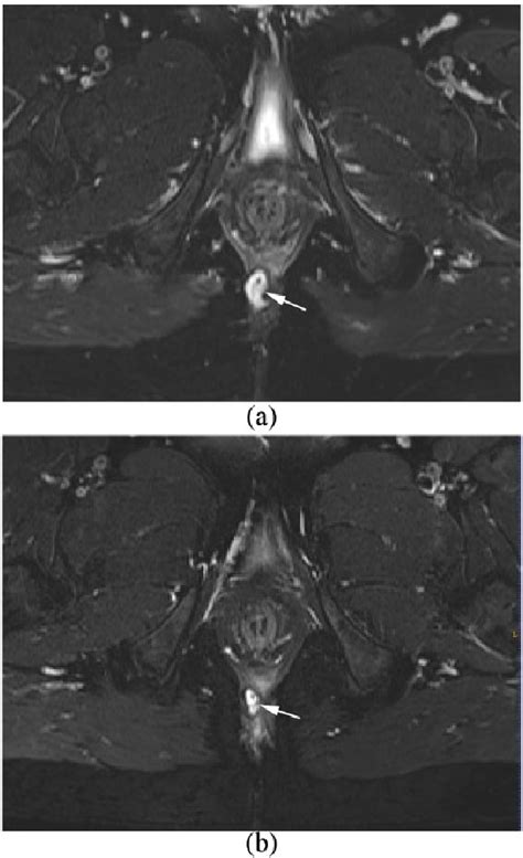 Figure From Volume Assessment Magnetic Resonance Imaging Technique