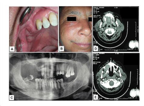 Maxillary Sinus Cancer