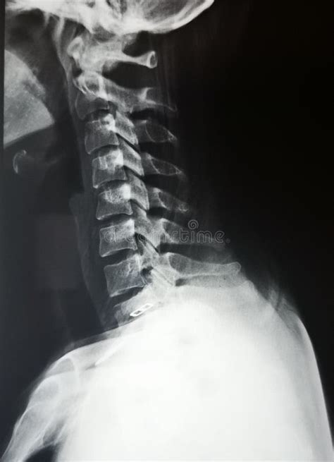 颈部和脊柱的x射线 库存照片 图片 包括有 人力 概要 诊断 脖子 伤害 爱好健美者 脊髓 223645414