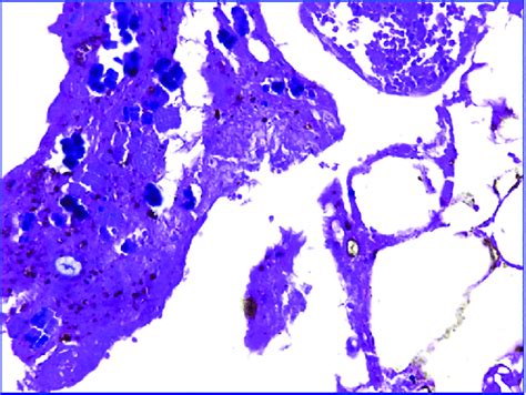 Sarcina Ventriculi Overgrowth And Necrotic Debris Hematoxylin Eosin