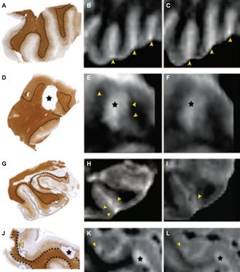 Post Mortem MRI And Histopathology In Neurologic Disease A