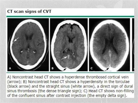 Cerebral Venous Thrombosis