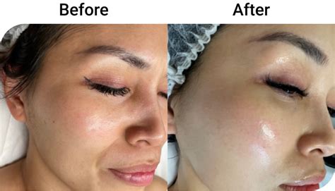 Gardenia Skin Co S Pico Laser Before And After