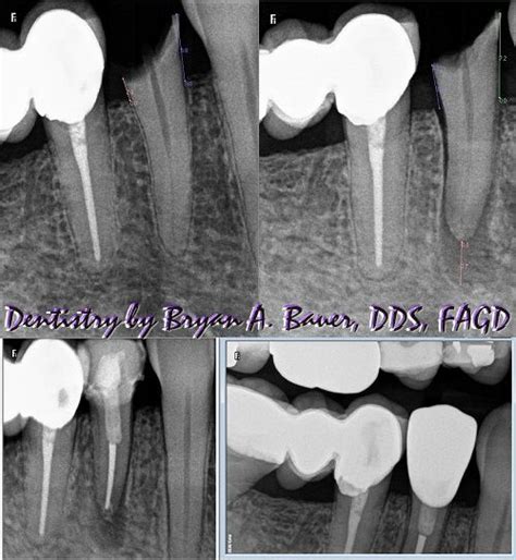 Surgical Extrusion Technique Partial Exodontic Technique P E T Bauer