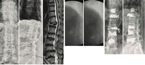 Demonstrated Radiographs Of A Year Old Female With T L Kyphosis