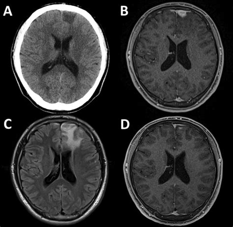 Figure Cerebral Syphilitic Gumma Within 5 Months Of Syphilis In Hiv