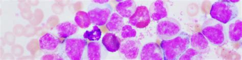 Chronic Lymphocytic Leukemia Cells