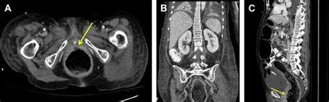 Evaluating The Patient With Left Lower Quadrant Abdominal Pain