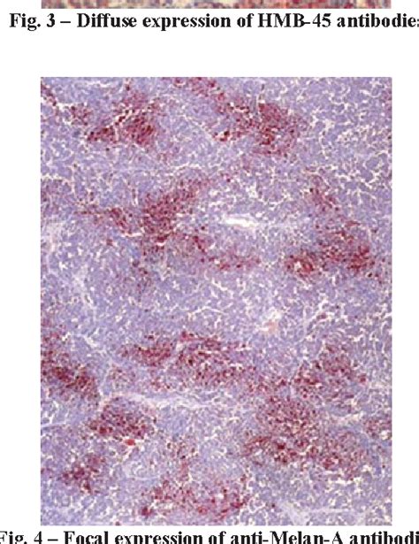 Figure From Metastatic Malignant Ovarian Melanoma A Case Report