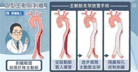 突然劇烈胸痛、背痛？小心可能是致命主動脈剝離，年輕也不能大意 健康遠見