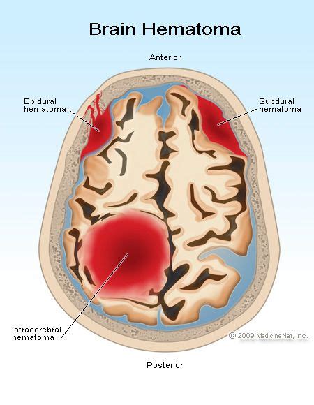 How To Spot A Stroke | Brain hemorrhage, Medical anatomy, Brain anatomy