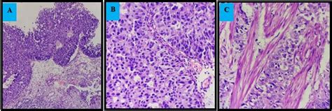 A Tumor Histopathology Of Colouration Of He 100x B Staining Of He