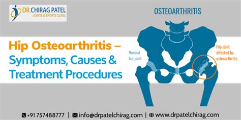 Hip Osteoarthritis Symptoms, Causes | Hip pain | Arthritis