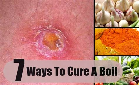 7 Ways To Cure A Boil Mzizi Mkavu