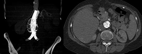 Treatment Of An Infrarenal Aneurysm With An Eccentric Calcified Lesion