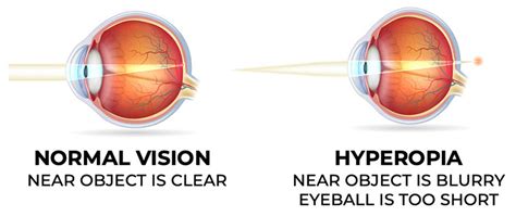 Farsighted Hyperopia Assil Gaur Eye Institute Los Angeles