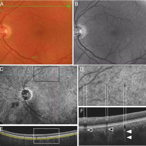 Multimodal Imaging Of Hard Punctate Lesions In Rhesus Macaques Fundus