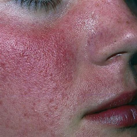 Folliculitis Face