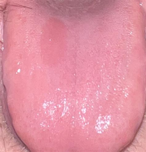 Strange Patch On Tongue Had It For Around 2 Weeks May Be A Burn R