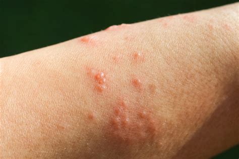 What Does Poison Ivy Rash Look Like Symptoms To Know Self