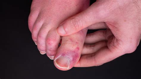 We might finally know what causes 'COVID toes' | Live Science